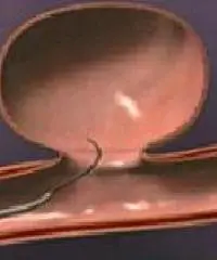 Aneurysm Endovascular Coiling: Advanced Minimally Invasive Treatment for Brain Aneurysms